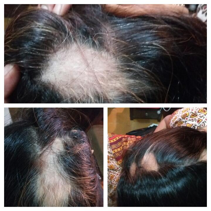 A Case of Alopecia Areata treated by Dr. Zinkal