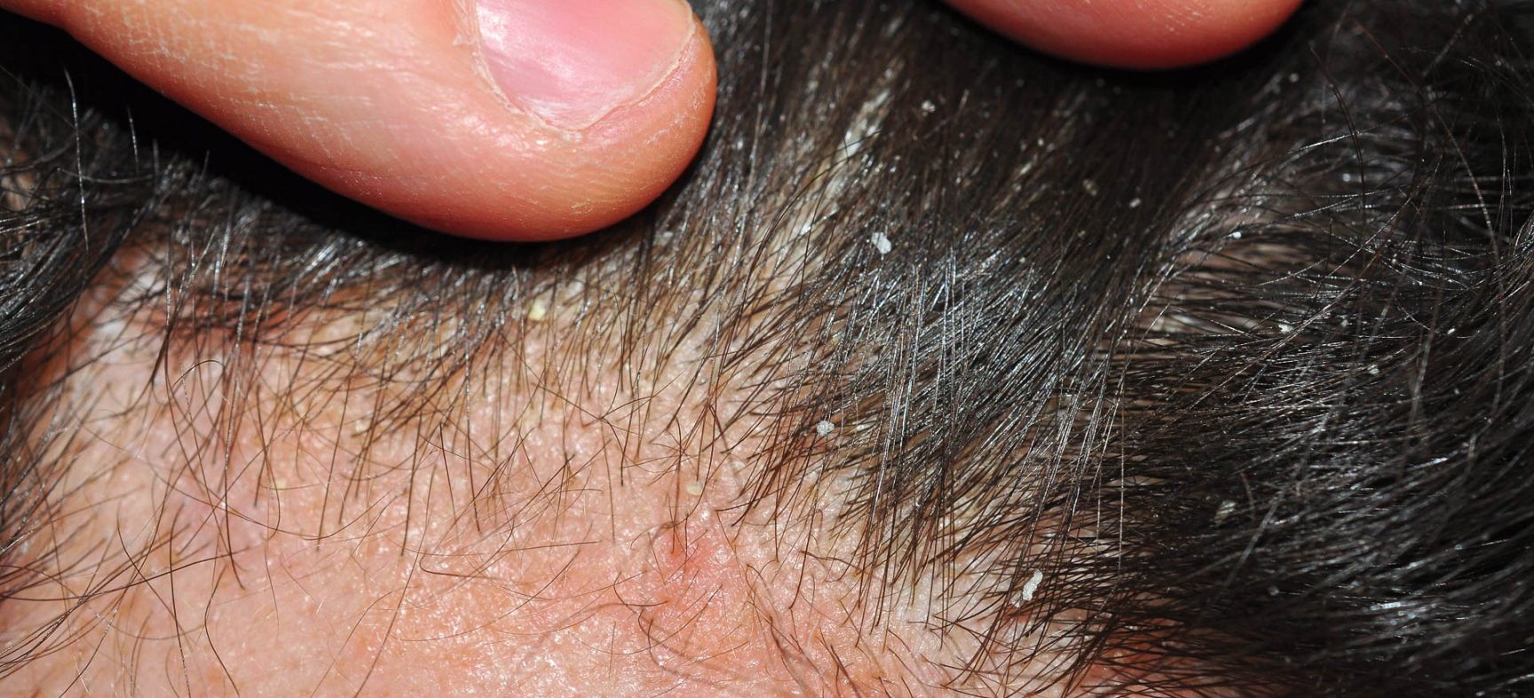 A Case of Hypotension and Scalp Psoriasis