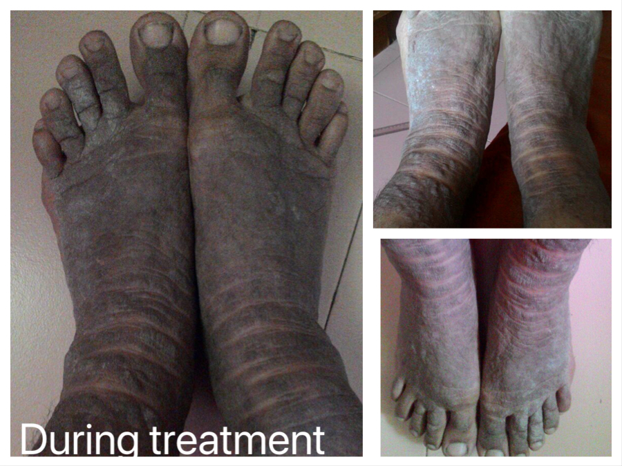 A Case Of psoriasis treated by Dr. Zinkal