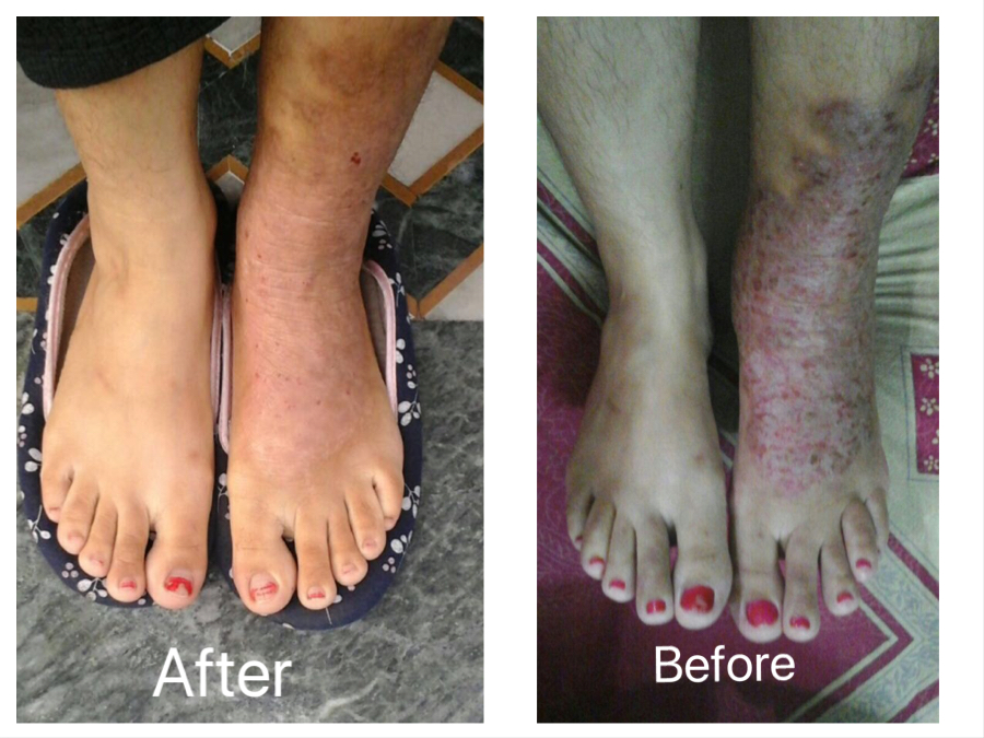 A Chronic Case of foot Psoriasis treated by Dr. Zinkal